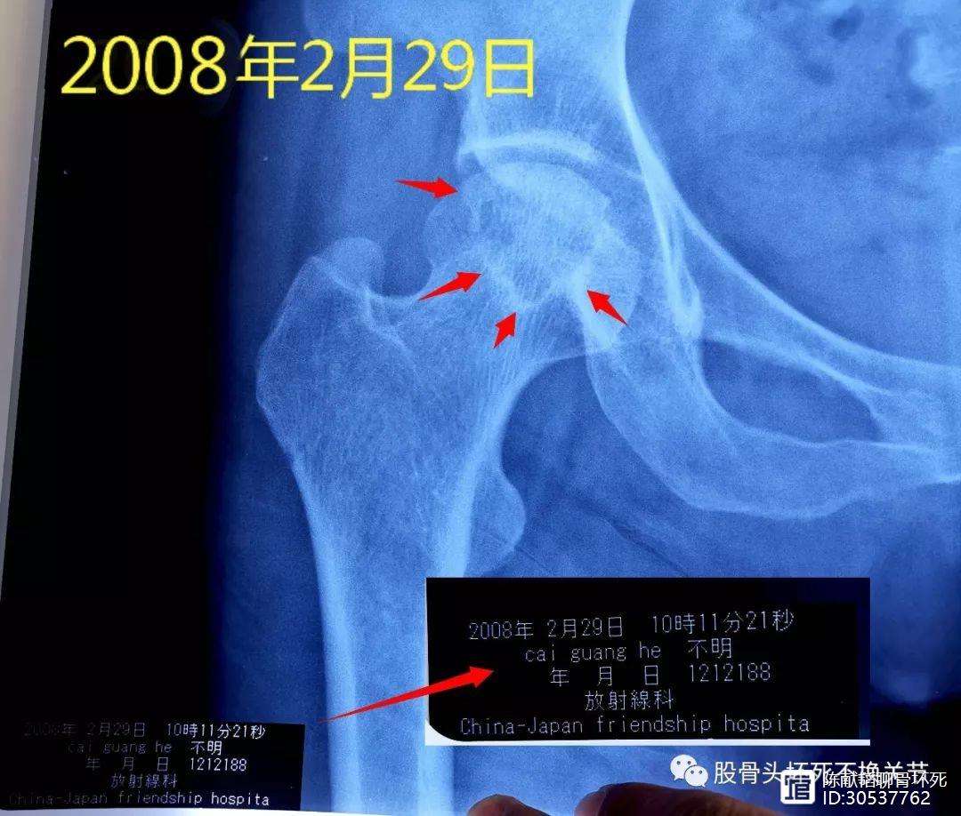 河源人工骨头医保报销多少(人工骨头医保报销多少比例)